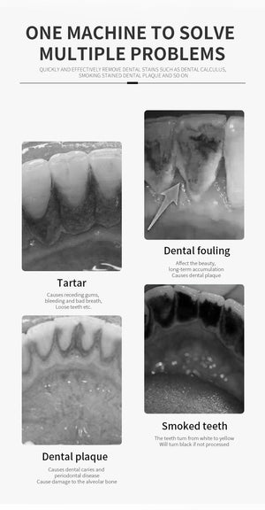 Teeth Cleaning Kit with LED Light 3 Working Modes Waterproof Ultrasonic Tooth Cleaner for Fighting Tartar